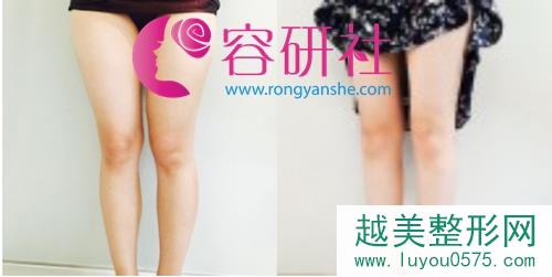 韩国dreamline吸脂塑形医院大腿吸脂对比图