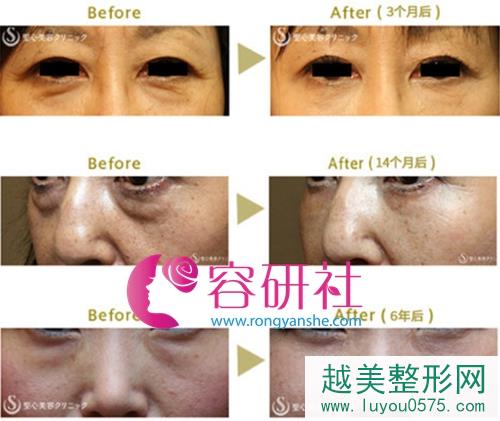 日本圣心医疗美容医院皮肤美容再生疗法真实案例