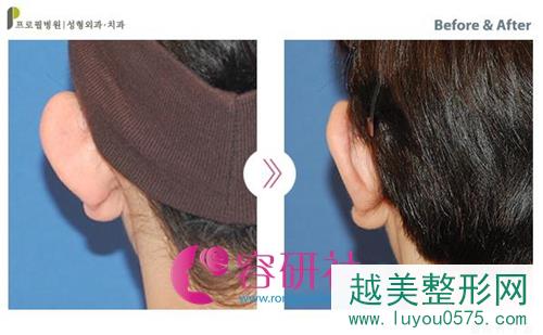 韩国普露菲耳profile整形医院招风耳颅耳角在30°-60°之间案例