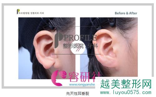 韩国普露菲耳profile  整形医院耳缺失改善手术案例
