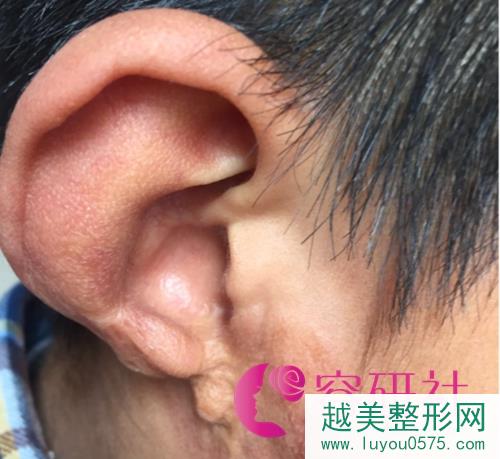 耳畸形耳确实耳朵有问题怎么办