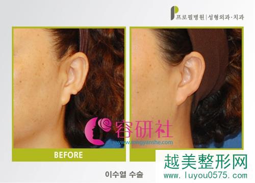 韩国普露菲耳profile整形医院耳缺失改善手术案例