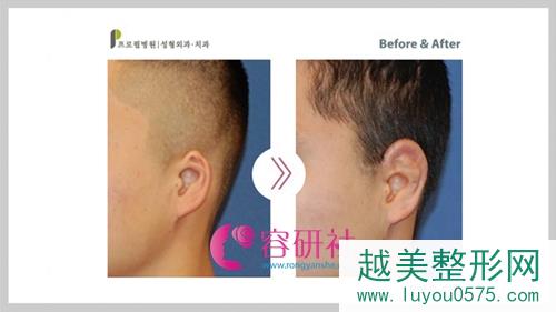 韩国普露菲耳profile颅耳角在30°-60°之间改善手术案例