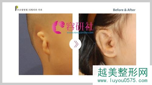 韩国普露菲耳（profile）整形外科医院小耳症案例