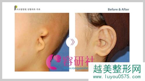韩国profile整形外科耳畸形耳再造手术案例