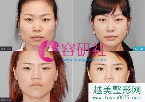 韩国profile医院郑在皓院长面部轮廓手术案例