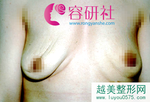 韩国普罗菲尔整形医院隆胸假体取出示例图