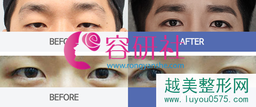 韩国普罗菲尔整形医院眼部整形案例1
