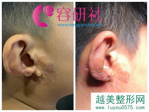 韩国普罗菲尔整形医院小耳畸形患者术前术后对比图