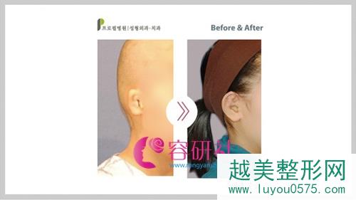 韩国普罗菲耳profile整形医院外耳廓畸形矫正案例