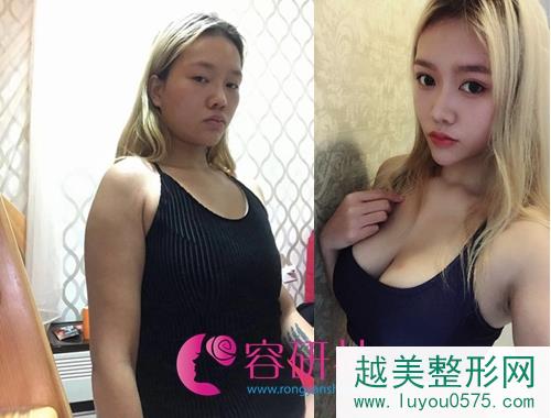 韩国profile普罗菲耳整形医院隆胸案例