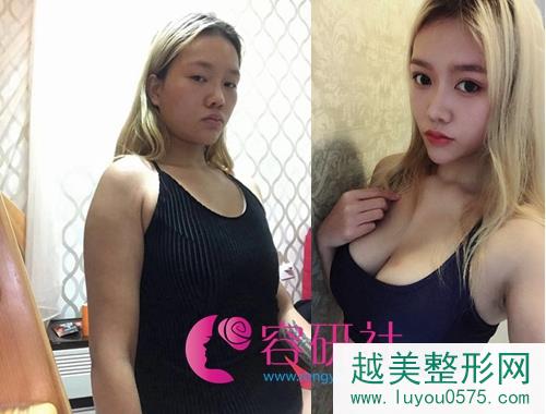韩国profile普罗菲耳整形医院假体隆胸案例