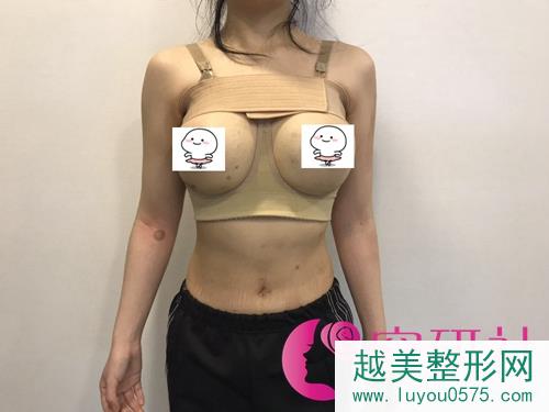 普罗菲耳profile—新氧达人陈米拉隆胸手术后果