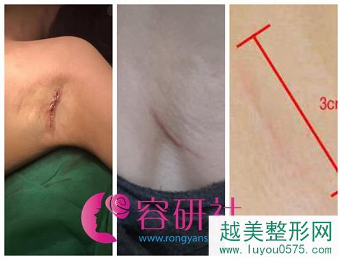 韩国普罗菲尔整形医院隆胸手术疤痕