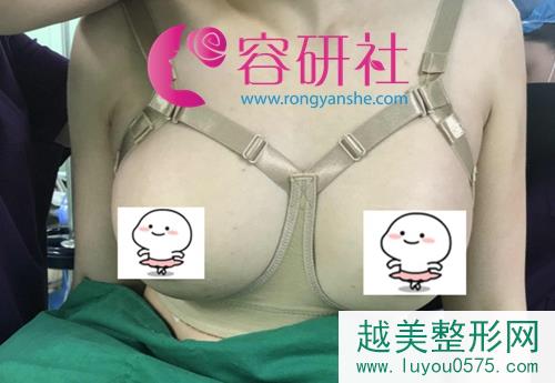 韩国普罗菲耳整形医院假体隆胸术后