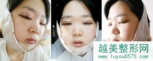 韩国新帝瑞娜医院双鄂手术案例术后三天