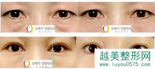 韩国欧米茄医院微创透明去眼袋手术案例
