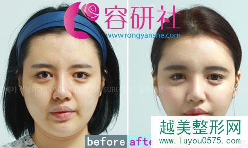 韩国欧米茄Omega整形医院脸部吸脂+双下巴手术案例