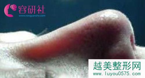韩国4月31日整形外科修复透光鼻