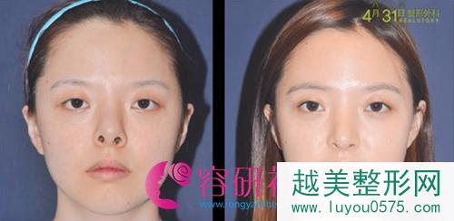 韩国4月31日整形外科鼻修复案例