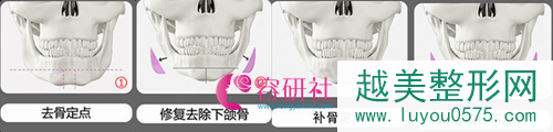 韩国创造美轮廓整形医院下颌角修复
