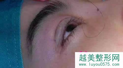 韩国纯真医院双眼皮手术缝合线体