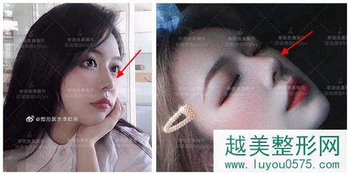 北京柏丽整形医院鼻整形大师李劲良医生鼻部手术手术案例