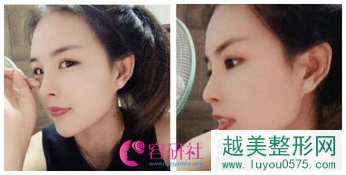 北京米杨丽格巫文云膨体隆鼻鼻修复案例