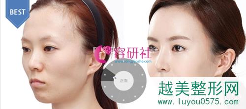 韩国丽珍整形外科面部改善手术案例