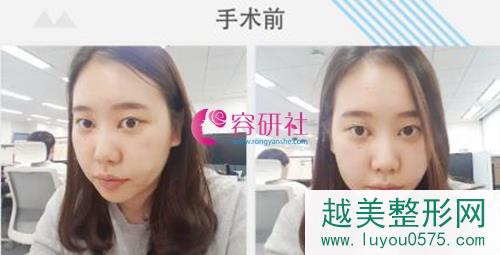 韩国NANA整形外科眼鼻部手术案例