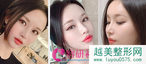 韩国秀美颜鼻修复术后6个月