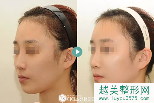 韩国TS整形外科鼻修复案例