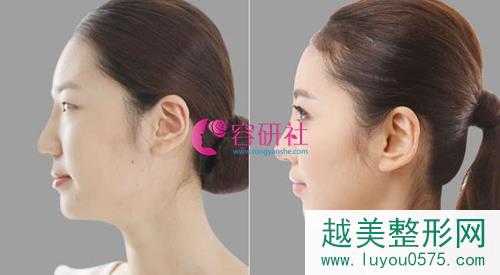 韩国欧佩拉整形外科鼻部手术手术案例