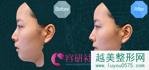 韩国菲斯莱茵面部轮廓术前3D模拟
