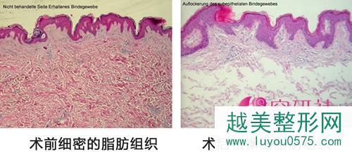 韩国迪美丽使用LDM吸脂术后皮肤组织的变化
