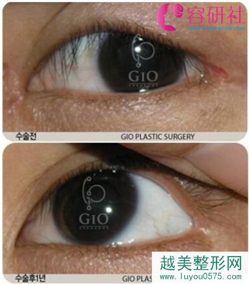 韩国GIO整形外科李胜勋眼睛修复手术
