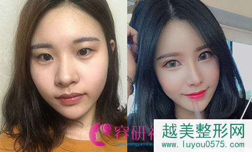 韩国秀美颜眼鼻手术术前术后对比