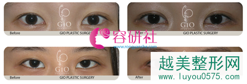 韩国gio整形外科双眼皮不对称修复案例