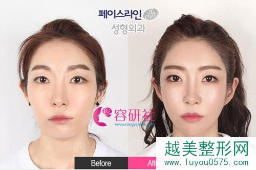 韩国菲斯莱茵、原辰和必妩，哪家做面部轮廓实力更强？