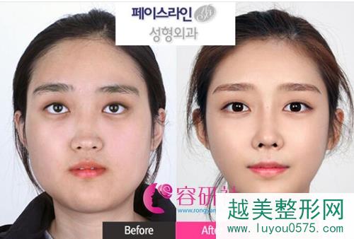 韩国菲斯莱茵、原辰和必妩，哪家做面部轮廓实力更强？