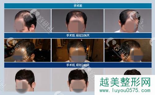 韩国毛杰琳整形外科男士秃顶改善案例