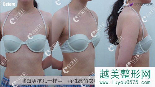 韩国jw整形医院假体隆胸术前照片