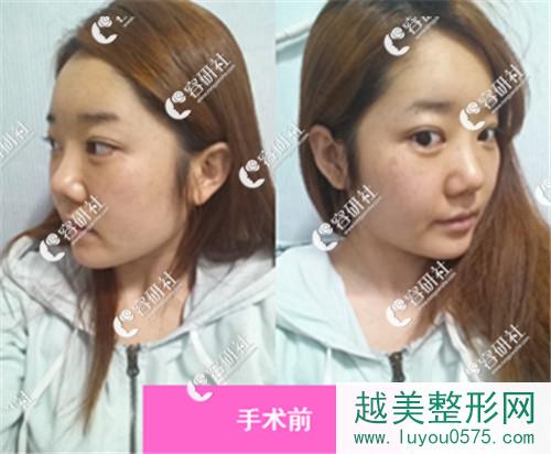 韩国id整形医院朴相熏下颌角手术前案例照片