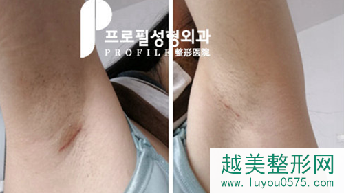 韩国profile普罗菲耳整形医院代表院长腋下疤痕
