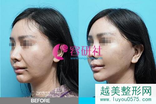 韩国歌娜整形外科柳京瀚院长下颌线提升案例