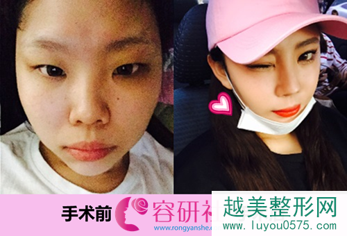 韩国id整形医院鼻部手术手术前后对比