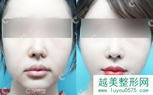 韩国歌娜整形医院迷你拉皮手术案例