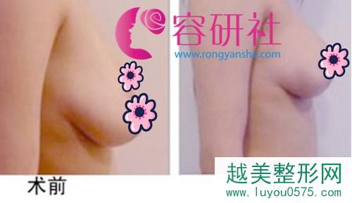 乳房下垂矫正术前后对比图
