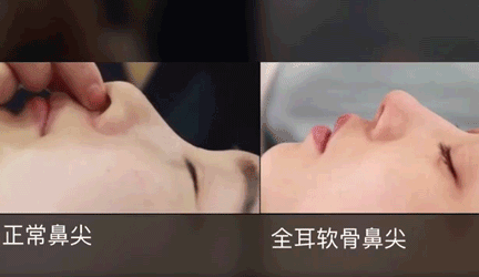 北京联合丽格的师俊莉院长术后鼻尖形态