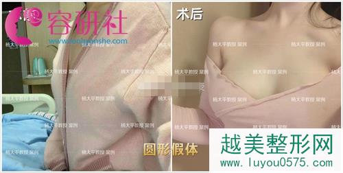 北京联合丽格的杨大平教授假体隆胸案例